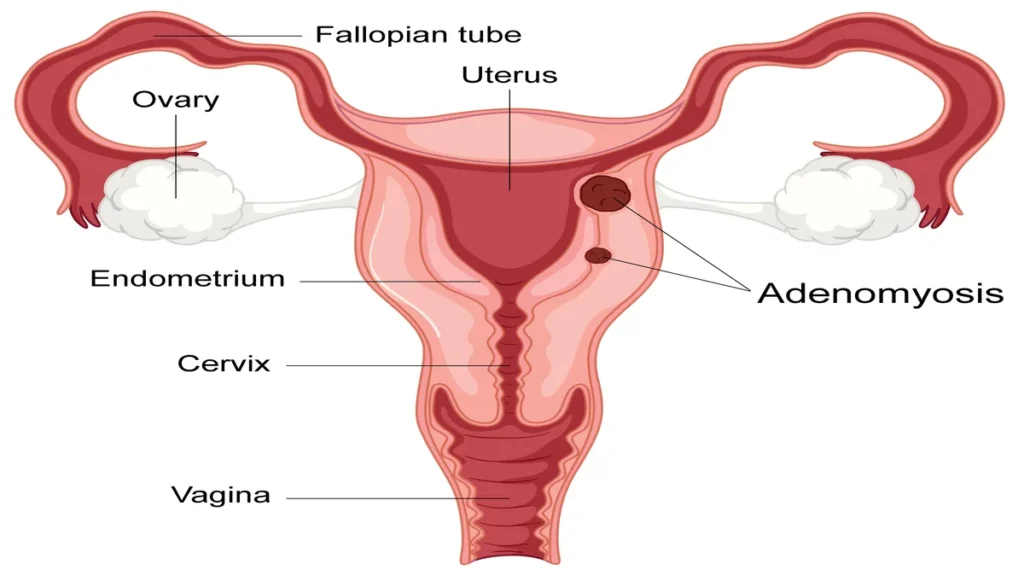 Understanding Adenomyosis: Symptoms, Diagnosis, and Treatment