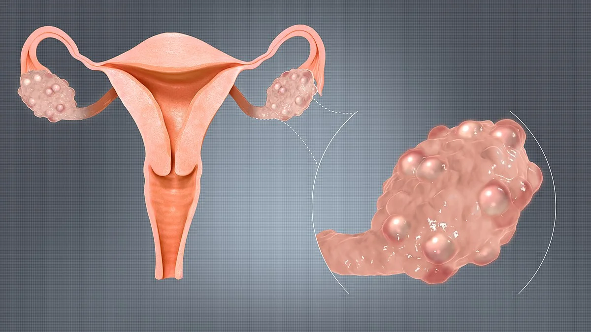 Understanding PCOS
