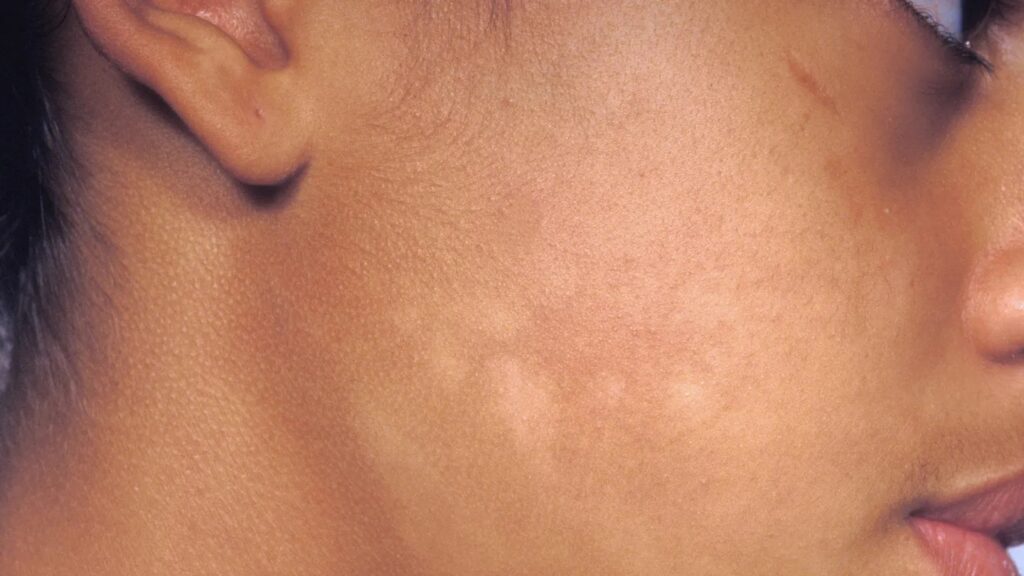 Early Signs of Vitiligo in Women