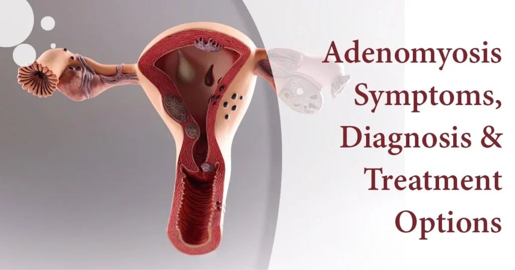 Understanding Adenomyosis: Symptoms, Diagnosis, and Treatment